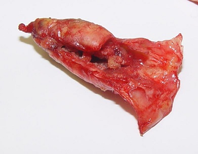 Po odstranitvi strdka iz vratne arterije je možnost kapi občutno manjša